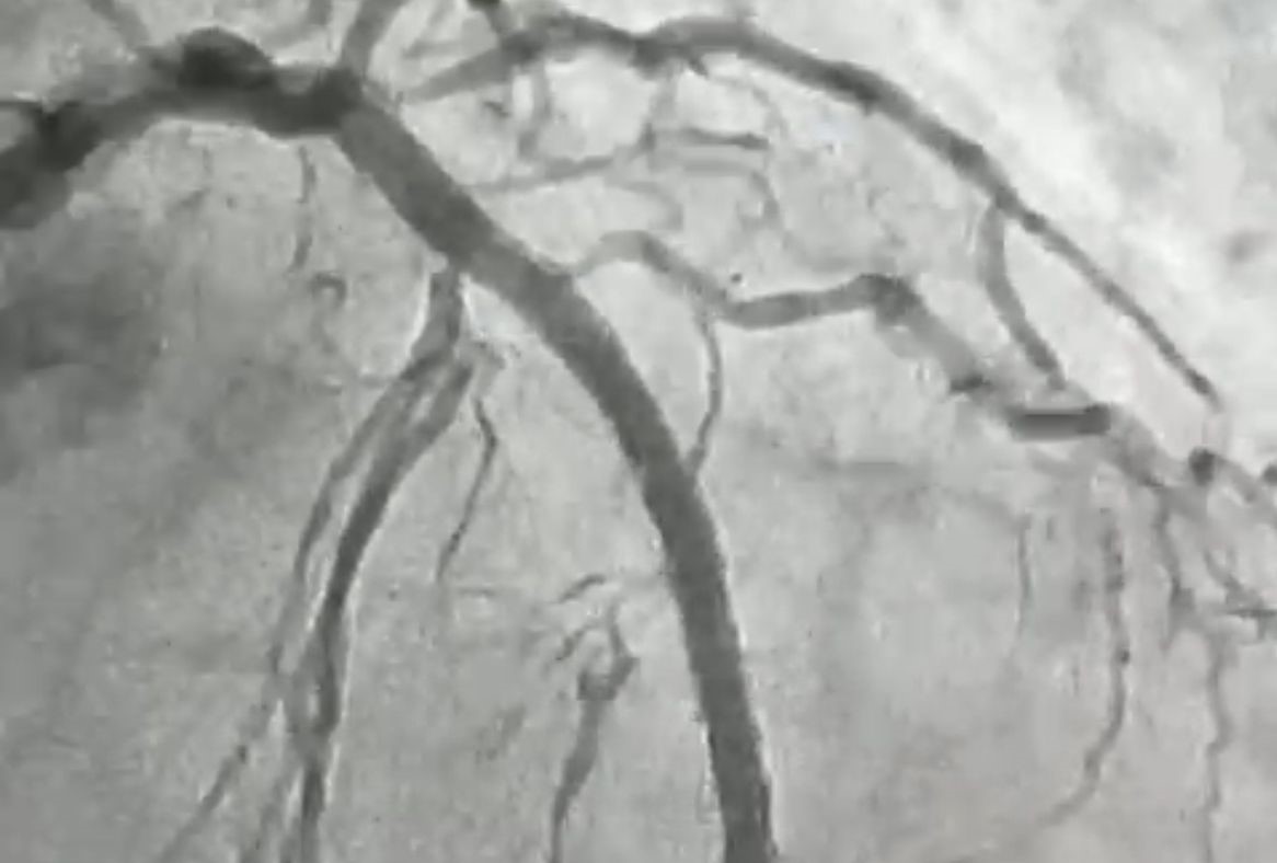 Hemodinâmica de Patos realiza procedimento cardiovascular inédito (1).jpeg