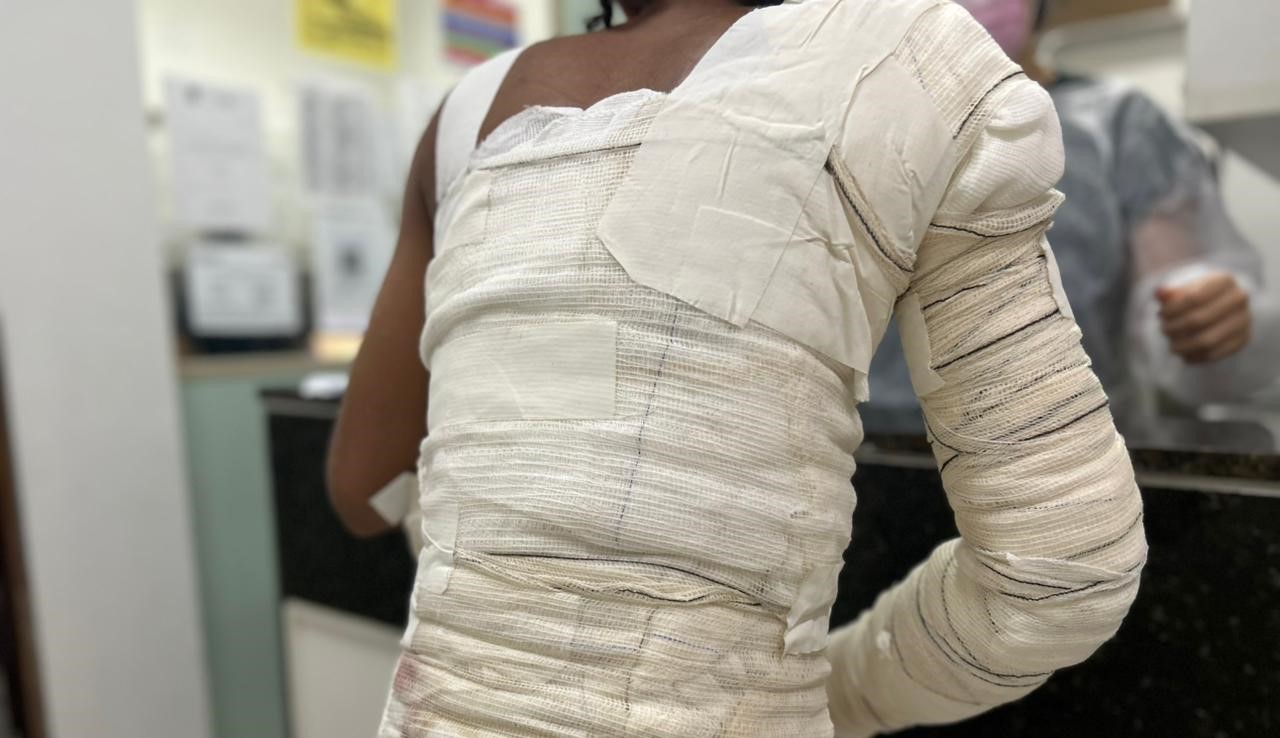 queimaduras (2).jpeg