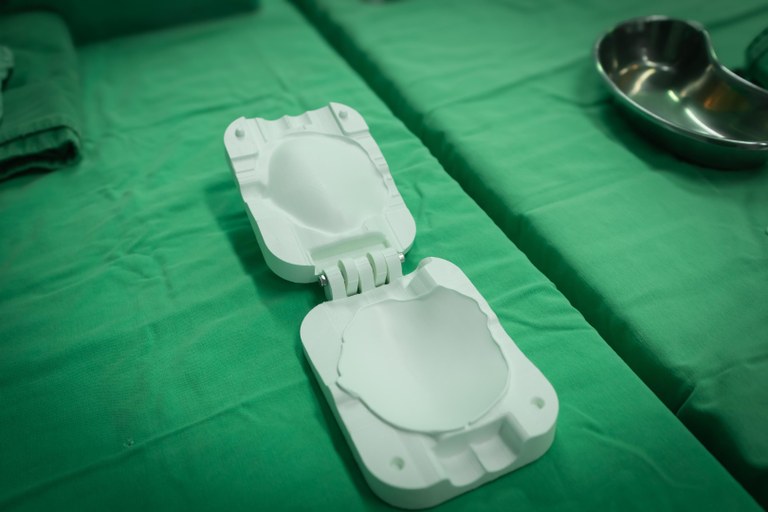 cranioplastia com prótese prototipada (4).jpeg