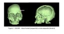 cranioplastia com prótese prototipada (6).jpeg