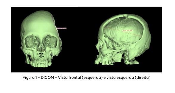 cranioplastia com prótese prototipada (6).jpeg