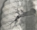Recurso de alta complexidade Trombectomia mecânica salvou a vida de sertanejos na Hemodinâmica de Patos (02).jpeg
