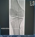Procedimento inédito na Hemodinâmica de Patos salva mais um paciente no Sertão da Paraíba (2).jpeg