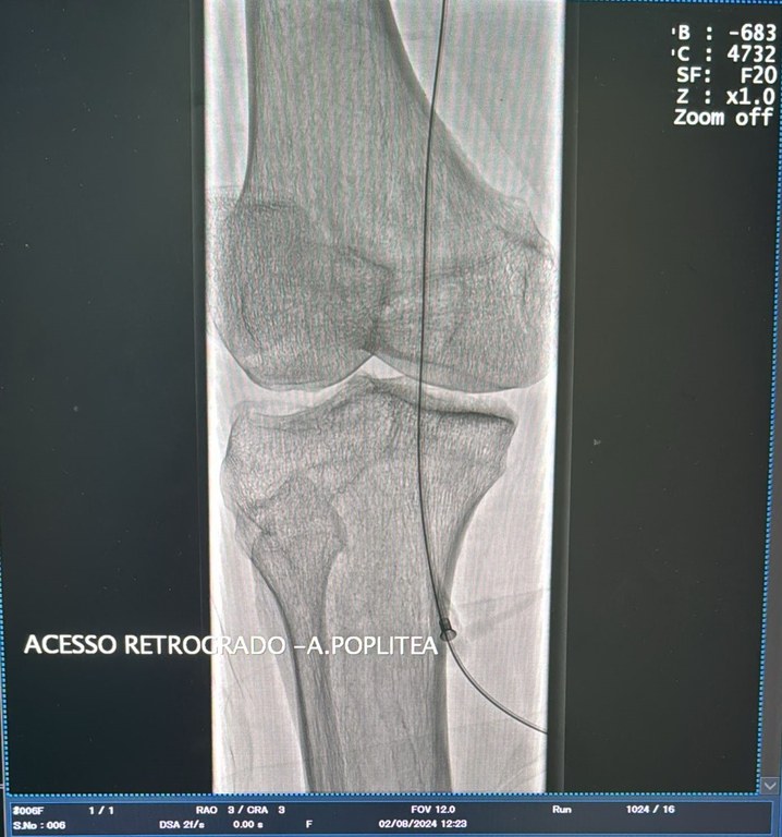 Procedimento inédito na Hemodinâmica de Patos salva mais um paciente no Sertão da Paraíba (2).jpeg