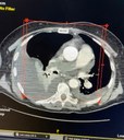 trombectomia mecânica 1.jpg